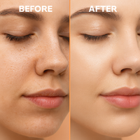 HailiCare Blackhead Remover and Pore Cleaner